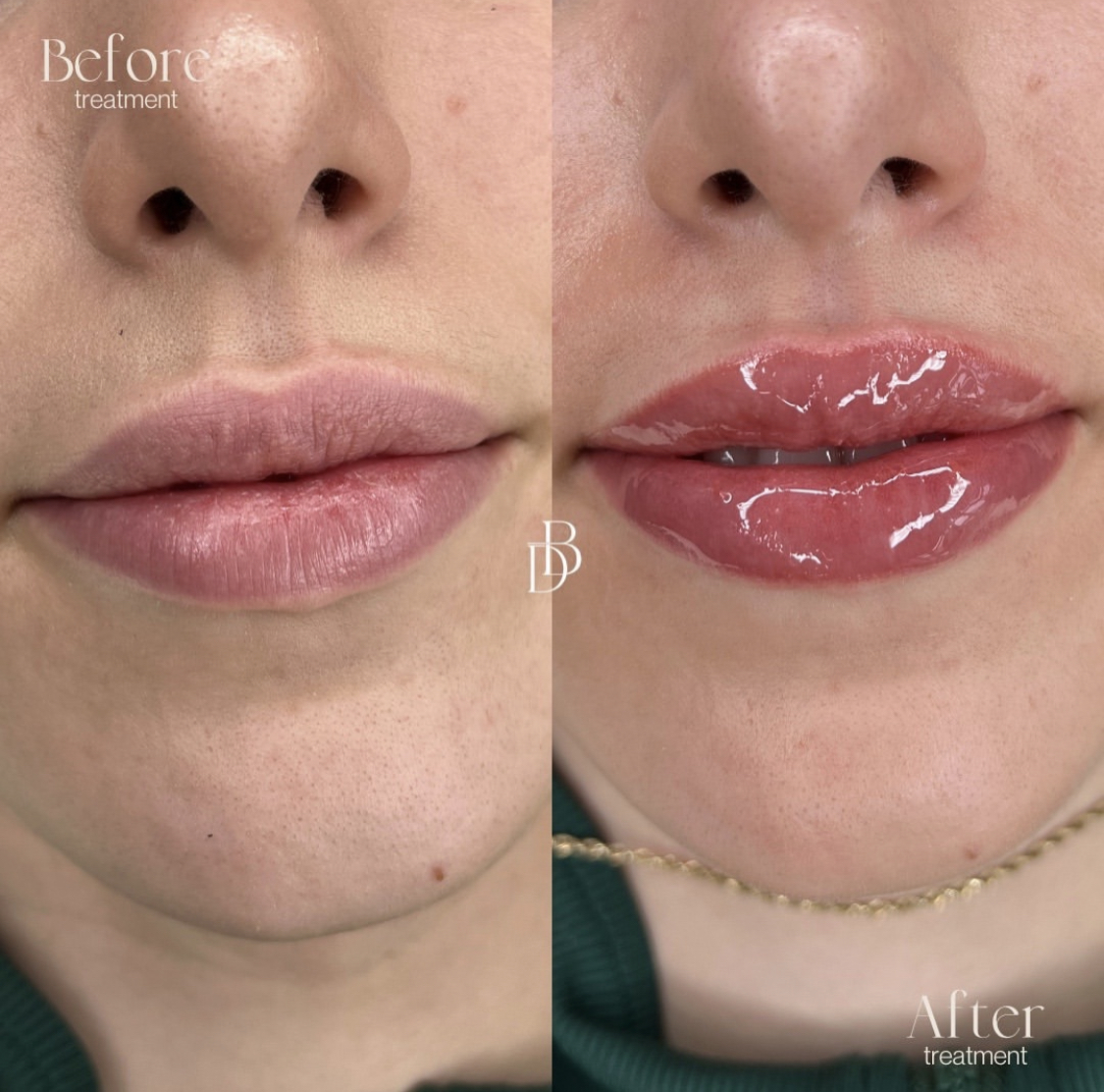 Before and after of a woman with full lips with lip blush tattoo