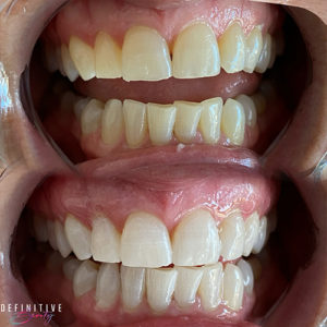 teeth-whitening-near-syracuse-ny-image-of-whitening-results-from-definitive-beauty-300x300