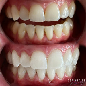 teeth-whitening-near-syracuse-ny-images-of-white-teeth-results-from-definitive-beauty-300x300
